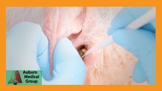 Chucks Tough Ear Wax Removal Part 1  Auburn Medical Group [upl. by Aleahpar]