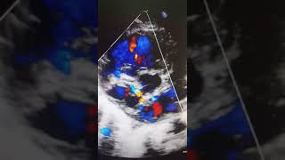 Case 30 echocardiography Right coronary artery fistula to Left atrium [upl. by Ainezey]