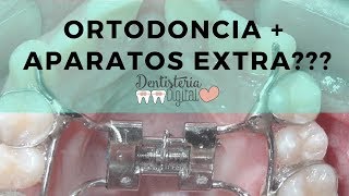 ORTODONCIA  APARATOS EXTRA Para qué sirven [upl. by Filmer]