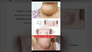 Goiter disease lack of iodine drugeducation medicalstudent [upl. by Sugden938]