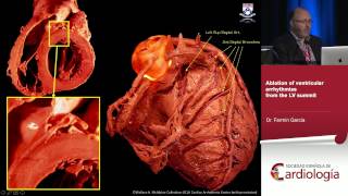 Ablation of idiopathic left ventricular tachyarrhythmias [upl. by Eneleuqcaj]