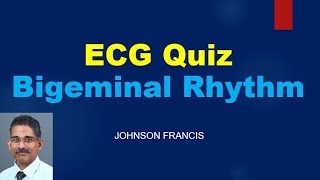 ECG Quiz  Escape – Capture Bigeminy [upl. by Blisse]