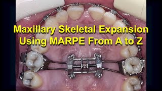 Maxillary Skeletal Expansion using MARPE from A to Z Updated [upl. by Eedia]