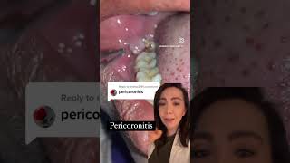 Uncovering the Mystery of Pericoronitis  You Wont Believe What It Is [upl. by Conover]