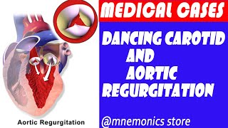 AORTIC REGURGITATION AND DANCING CAROTIDs All You Need To Know [upl. by Erdrich241]