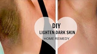 HOW TO LIGHTEN DARK UNDERARMS  SKIN NATURALLY amp FAST  amp DIY for Knees Elbows Thighs 100 WORKS [upl. by Eednus]