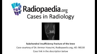 Subchondral insufficiency fracture of the knee Radiopaediaorg Cases in Radiology [upl. by Shaver]