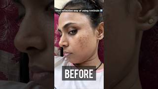 How to use Tretinoin Cream for most effective results Tretinoin before and after skin ✨shots [upl. by Odnarb]