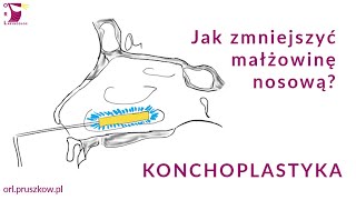 Jak zmniejszyć małżowinę nosową  Konchoplastyka [upl. by Koy]