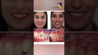 Miracle of Orthodontics Pre and Post orthodontic orthodontics orthodontist before after brace [upl. by Nayrbo79]