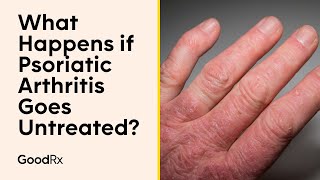 What Happens if Psoriatic Arthritis Goes Untreated  GoodRx [upl. by Einahteb15]