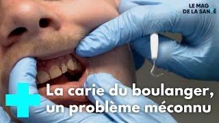 Prévenir la carie du boulanger  Le Magazine de la Santé [upl. by Grochow]