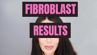 Plasma Pen Fibroblast Skin Tightening Everything You Need to Know  Treatment Review Before amp After [upl. by Branen974]