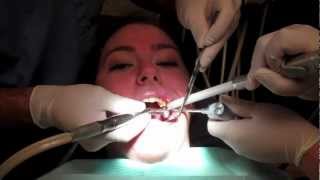 What Is It Like To Get A Filling In Your Tooth With Footage From The Dentists Office [upl. by Nwahsiek]