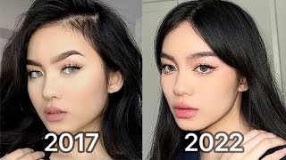 How I Changed My Face lip injections amp botox after 5 years [upl. by Qulllon]