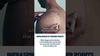 Are Infraspinatus Trigger Points Causing You Pain [upl. by Terrag]