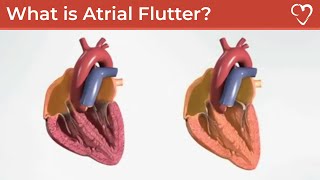 What is Atrial Flutter [upl. by Richara]