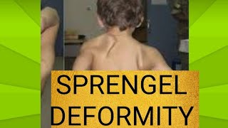 What is SPRENGEL DEFORMITY orthopedic [upl. by Yebloc157]