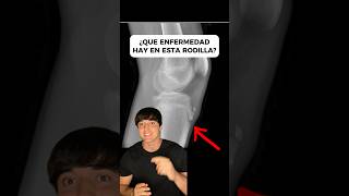 El OsgoodSchlatter EXPLICADO [upl. by Celik]