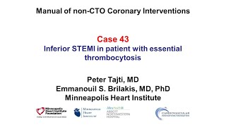 Case 43 PCI Manual  STEMI in a patient with essential thrombocytosis [upl. by Isiah]