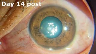 Surgical aspect of treating a corneal ulcer [upl. by Macknair14]