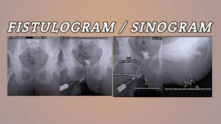 FistulogramSinogram [upl. by Mcripley]