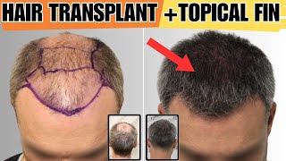 The BEST Treatment For Hair Loss HTFin  Choiexpert [upl. by Ogram518]