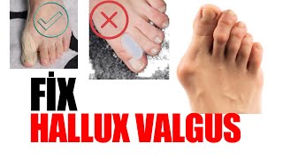 Fix Hallux Valgus  Hallux Valgus Taping  Pt Aynur BAÅ˛ [upl. by Asek]