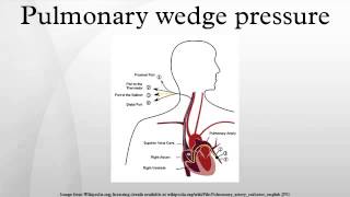 Pulmonary wedge pressure [upl. by Eidnam427]