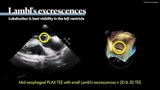 〖Echocardiography〗 Lambls excrescences amp fibroelastoma in TEE 🫀 [upl. by Einahpad236]