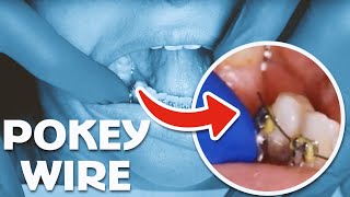 How to Fix a Pokey Wire in Your Braces At Home Using Orthodontic Wax [upl. by Cyprian395]