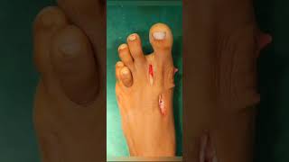 Hallux valgus correction Dr Kashyap Ardeshana [upl. by Kendra646]