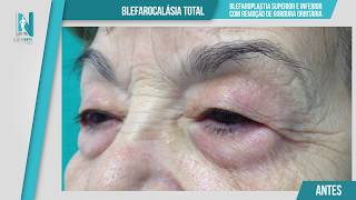 Dermatocalásia com bolsas adiposas das 4 pálpebras [upl. by Tilagram]