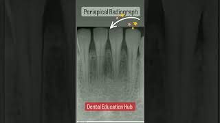 Periapical Radiograph  Dental Xray [upl. by Chaffinch]