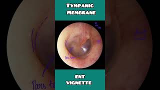 Tympanic membrane anatomy under 60 seconds  USMLE NCLEX  NEET PG [upl. by Eibrab]