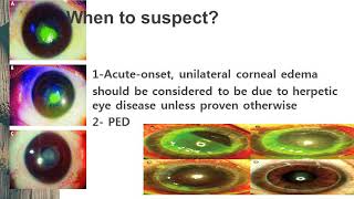 Herpetic keratitis [upl. by Robson]