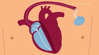 Implantation dun stimulateur cardiaque au Centre de cardiologie de lHôpital universitaire de Bâle [upl. by Esylle824]