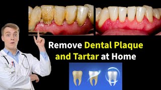 Simple Remedy for Dental Plaque and Tartar Removal at Home [upl. by Mychal]