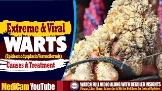 Shocking Extreme Viral Warts  Causes And Treatment [upl. by Malvia]