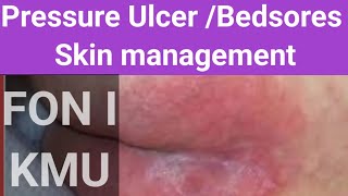 Bedsores  pressure ulcer skin management FON l KMU new 2024 [upl. by Dnumyar7]