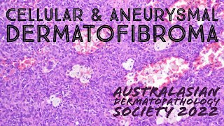 Cellular Dermatofibroma amp Aneurysmal Dermatofibroma 101 pathology dermpath dermatology [upl. by Aiekat568]