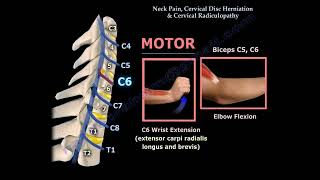 Neck Pain Cervical Disc Herniation amp Radiculopathy [upl. by Amlus]