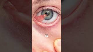 ¿Carnosidad en los ojos👩🏻‍⚕️ salud ojos pterigión oftalmologia shorts [upl. by Icak161]