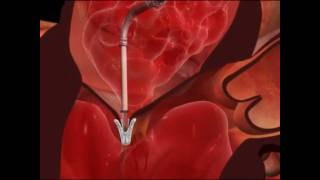 Mitral Valve Clip Repair ProcedureHow It Works [upl. by Wiles]