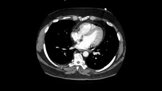 Pulmonary Embolism CTPA Interpretation 256 Shades of Grey Episode 2 [upl. by Tedi]