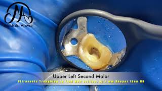 Ultrasonic Troughing to Find MB2 Orifice at 2 mm Deeper than MB Orifice in Upper Second Molar  RCT [upl. by Dnomyar]