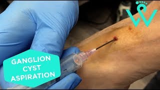 Ganglion Cyst Aspiration [upl. by Weisman]