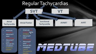 ECGs abnormal rhythms Regular Tachycardias [upl. by Melak]