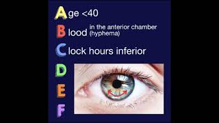 The ABCDEF Guide for Iris Nevus Growth to Melanoma by Carol Shields [upl. by Hsuk475]