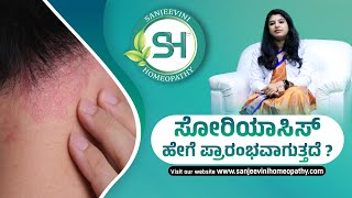 How does psoriasis starts  Main Causes amp Symptoms  Sanjeevini Homeopathy [upl. by Tiana29]